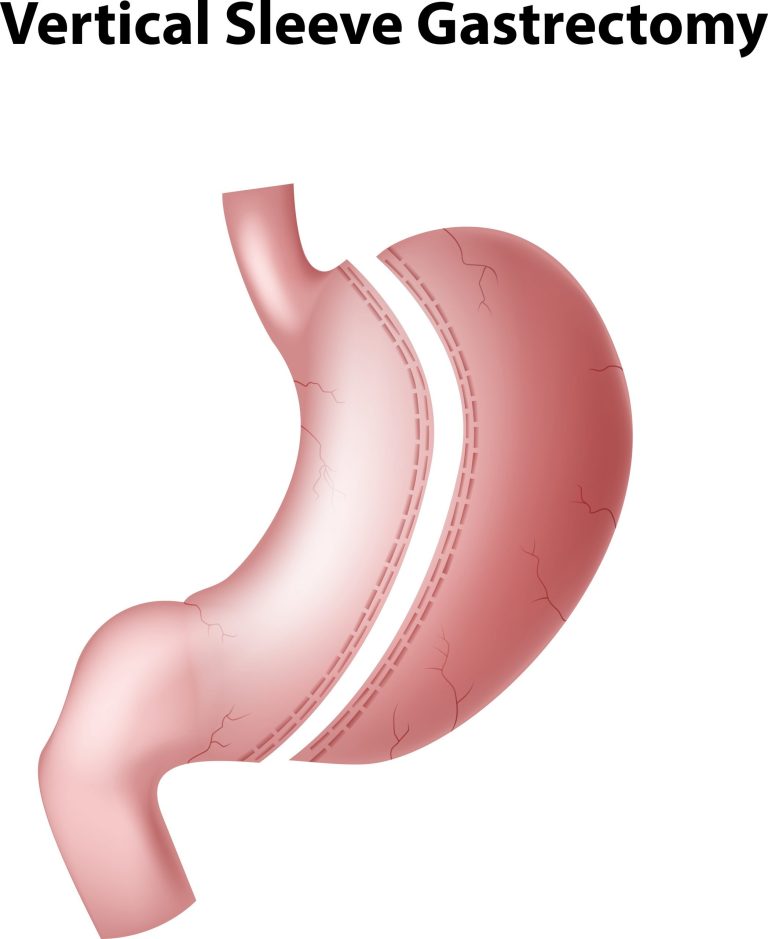 Bariatric
